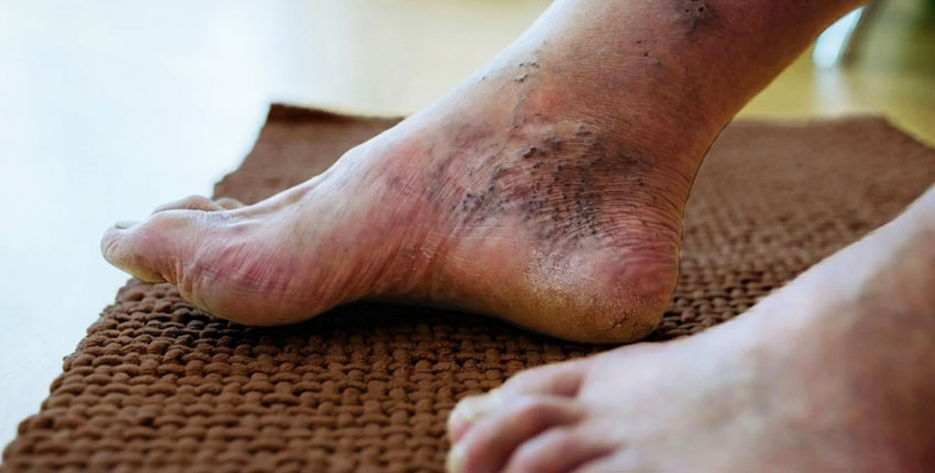 Diabetic Wound Management