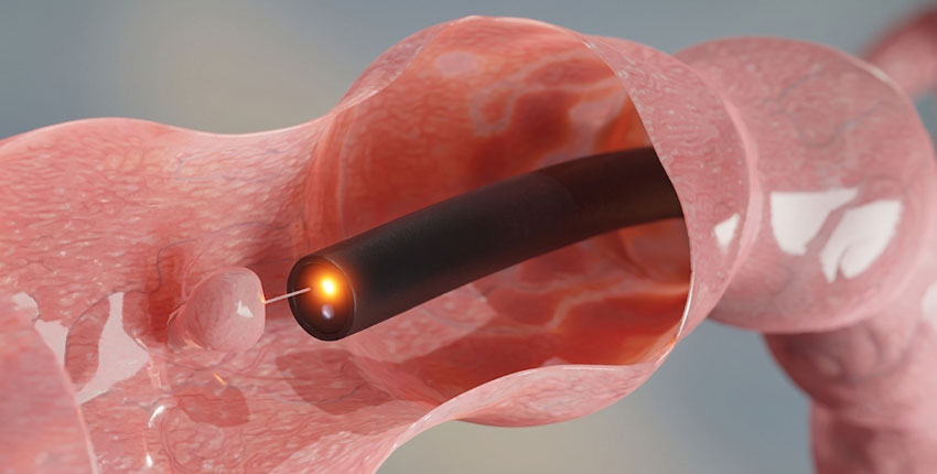 Colonoscopy