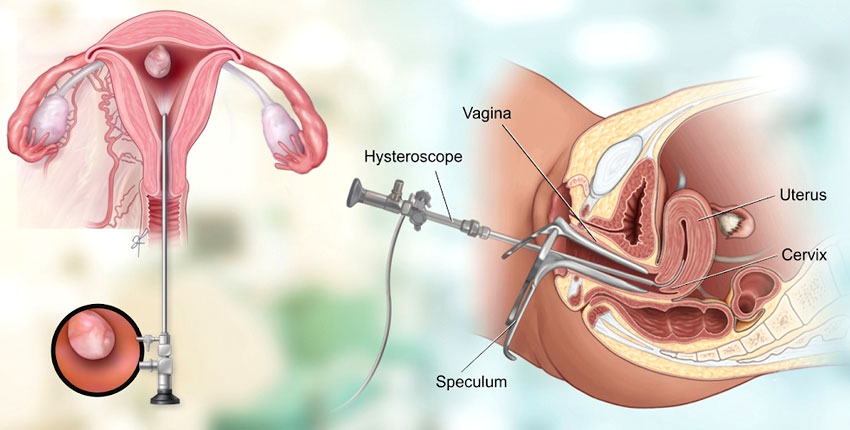 Hysteroscopy Surgeries