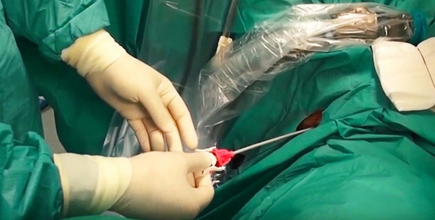 Endoscopic Kidney Stone Surgeries