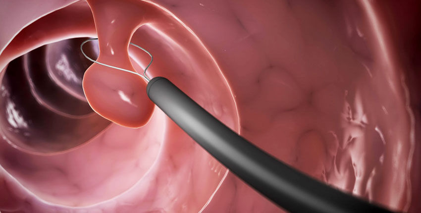 Endoscopic Polyp Removal Surgery