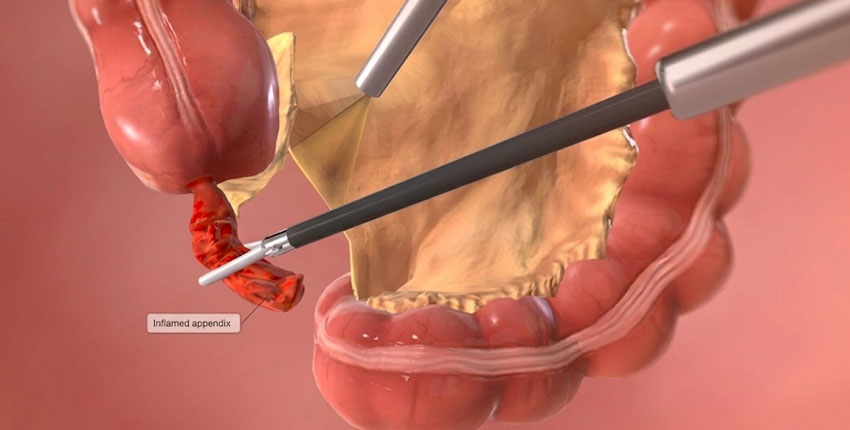Appendix Removal