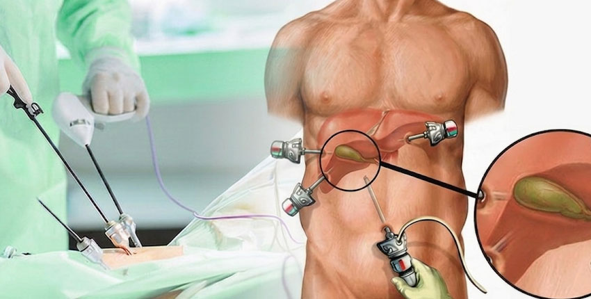 Gallbladder Removal