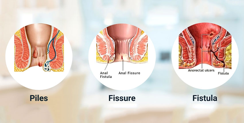 Laser Piles Fissure and Fistula Surgeries